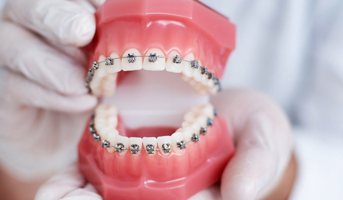 10 Benefits of Getting Braces – Beyond Smile 247