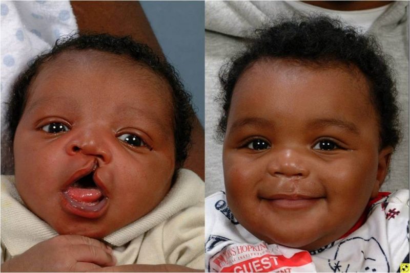 What You Need to Know About Cleft Lip and Cleft Palate Beyond Smile 247