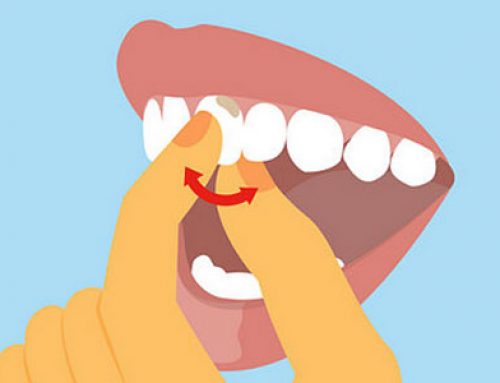 Tooth Mobility