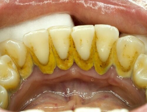 WHY REGULAR DENTAL CLEANINGS ARE MORE IMPORTANT THAN YOU THINK