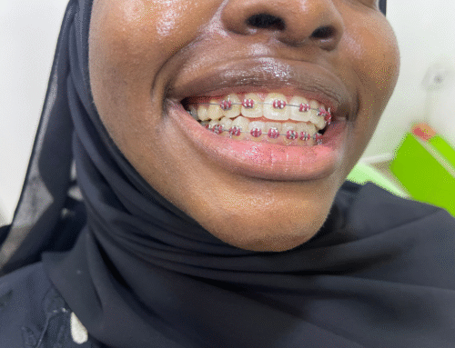 🦷 Everything You Need to Know About Braces