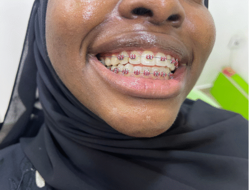 🦷 Everything You Need to Know About Braces