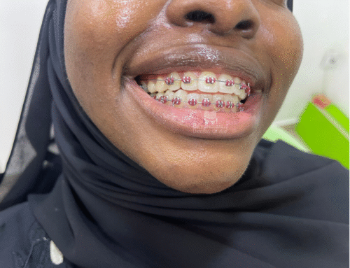 🦷 Everything You Need to Know About Braces
