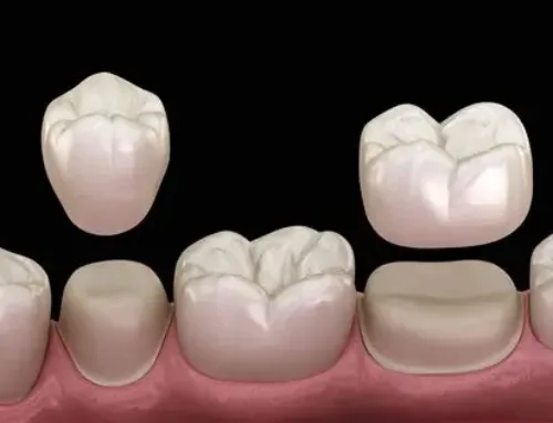 Dental Crowns